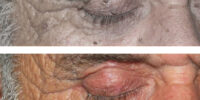 fibroma_skin_tag_difetti_pelle_occhi_1g