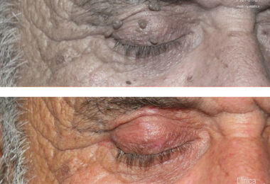 fibroma_skin_tag_difetti_pelle_occhi_1g