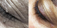 fibroma_skin_tag_difetti_pelle_occhi_2g