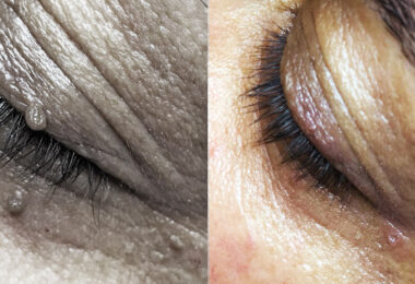 fibroma_skin_tag_difetti_pelle_occhi_2g