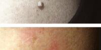 fibroma_skin_tag_difetti_pelle_occhi_3g