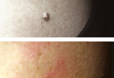 fibroma_skin_tag_difetti_pelle_occhi_3g